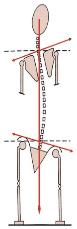 leg length scoliosis